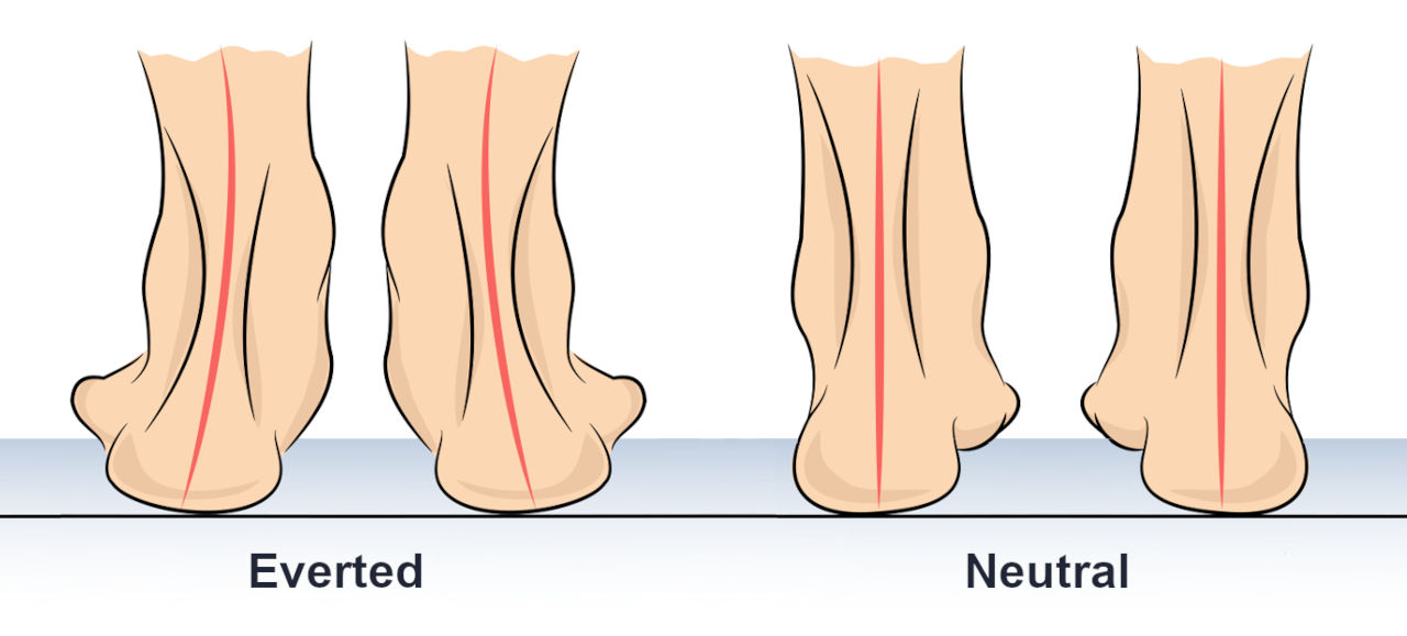 How To Fix Flat Feet - Somastruct