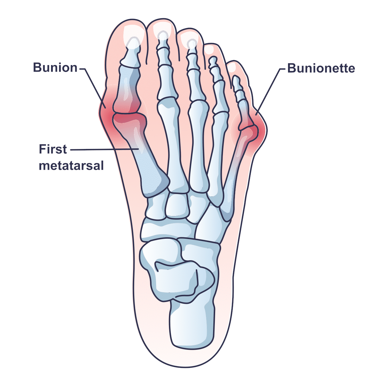 Bunion Correction - Somastruct